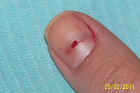 Reduced pooling within nail to relieve pain